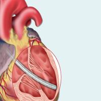 کانولای فمورالFEMORAL CANNULAE