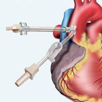 کانولای کاردیولوژیCARDIOPLEGIA CANNULAE